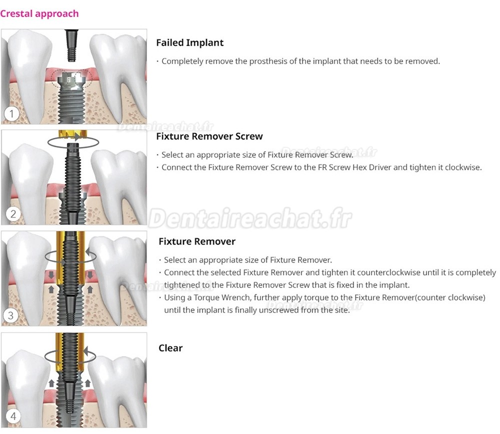 Kit d'extraction d'implants dentaires Neobiotech FR, clé dynamométrique à cliquet pour vis d'extraction